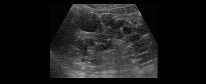 貓咪的多囊腎 polycystic kidney disease (PKD) in cats